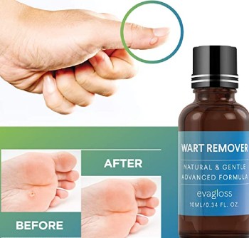 Natural-Wart-Remover-天然疣去除剂