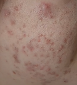 痘痘长不停？怎样改善和治疗长痘痘问题